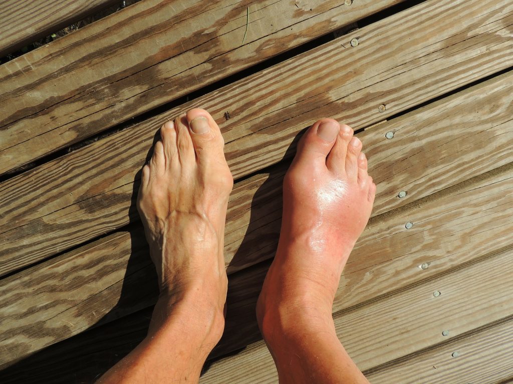 feet one foot swollen